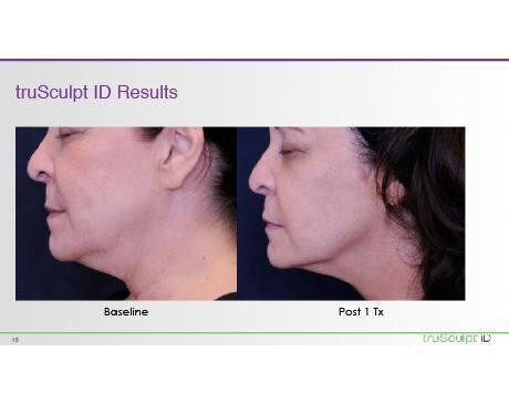 Zap the fat: Make an appointment for truSculpt ID